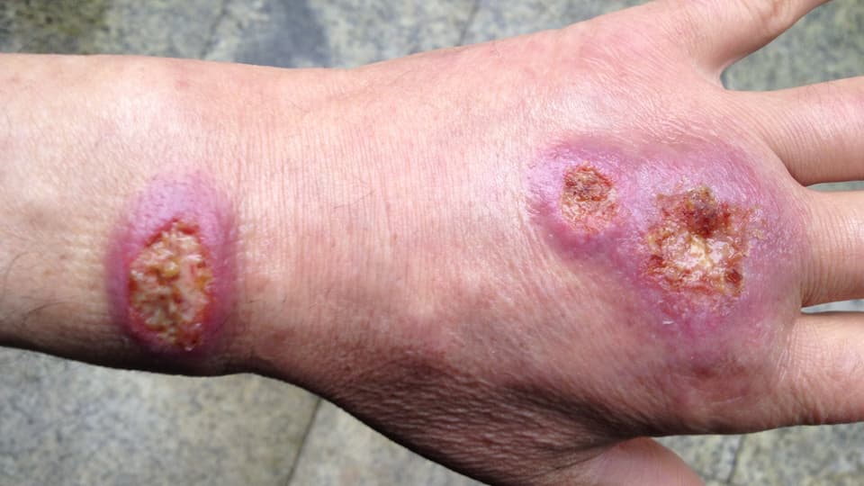 Tangan dengan tiga borok kulit yang disebabkan oleh leishmaniasis.