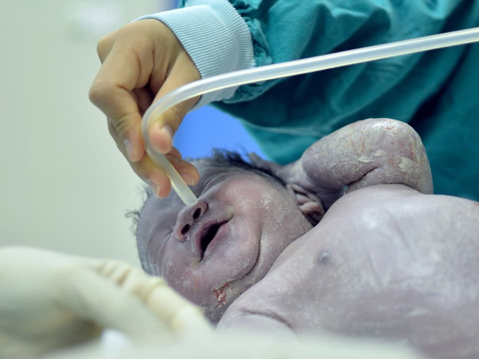 Bei einem Neugeborenen werden die Atemwege freigesaugt.