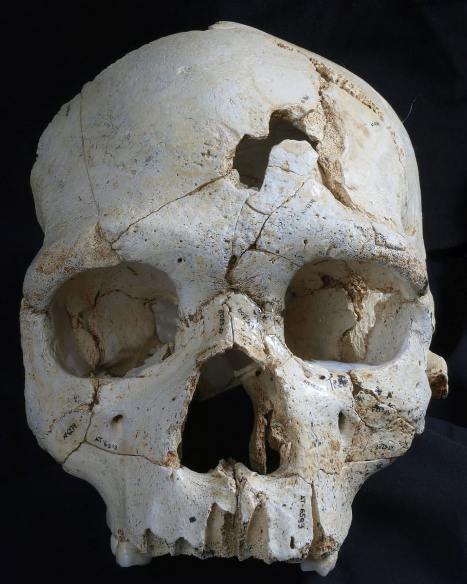 Ein menschlicher Schädel mit zwei Löchern im Stirnknochen.