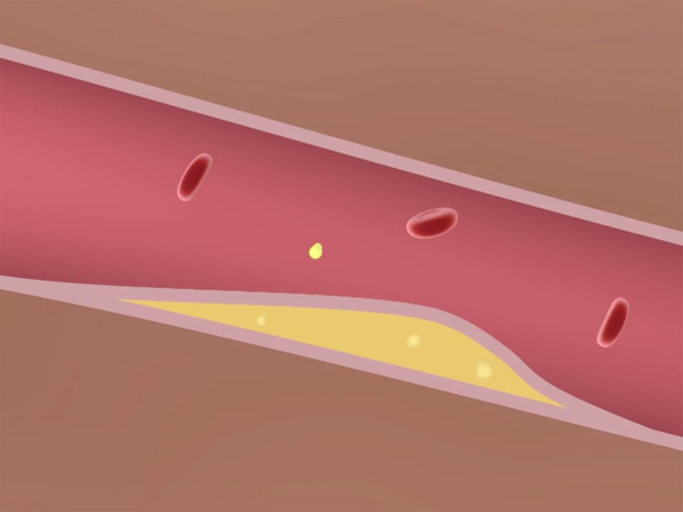 Grafischer Blick ins Innere eines Blutgefässes mit Ablagerungen
