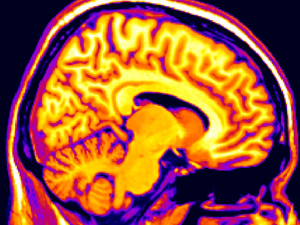 Querschnitt durch ein Hirn in Gelb- und Rottönen.