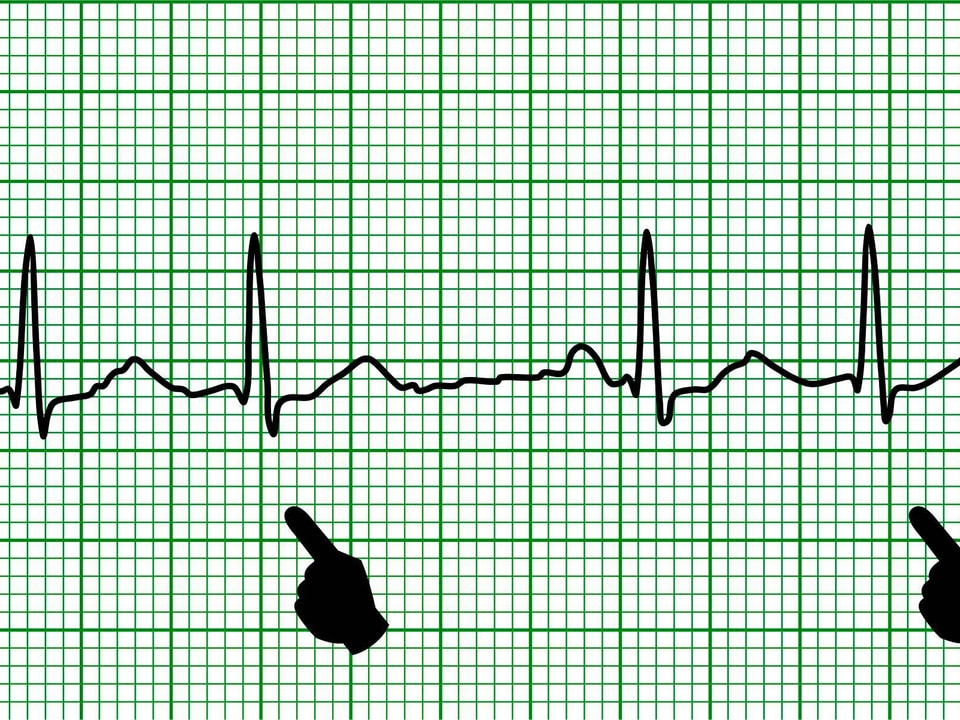 Extrasystolen auf einem EKG.