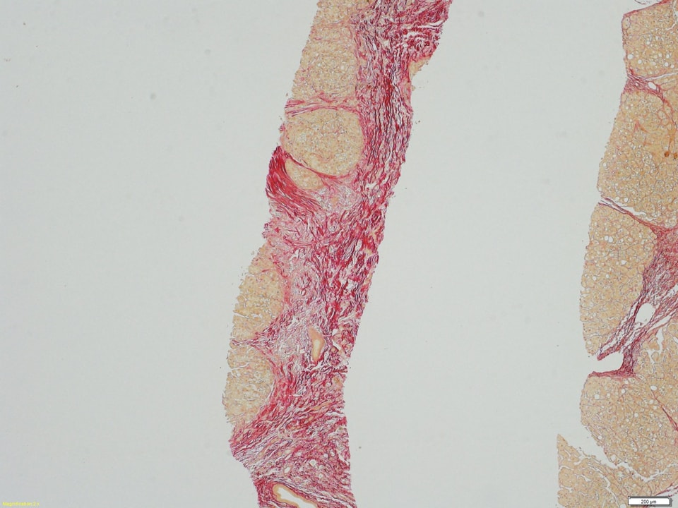 Biopsie eines stark vernarbten Lebergewebes.