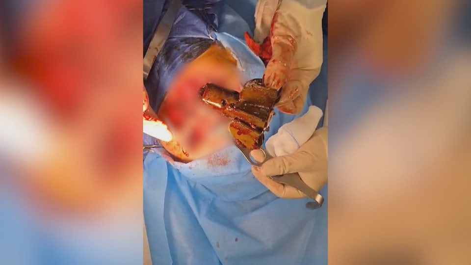 Bei einer Operation wird ein Geschoss aus einem menschlichen Körper entfernt.