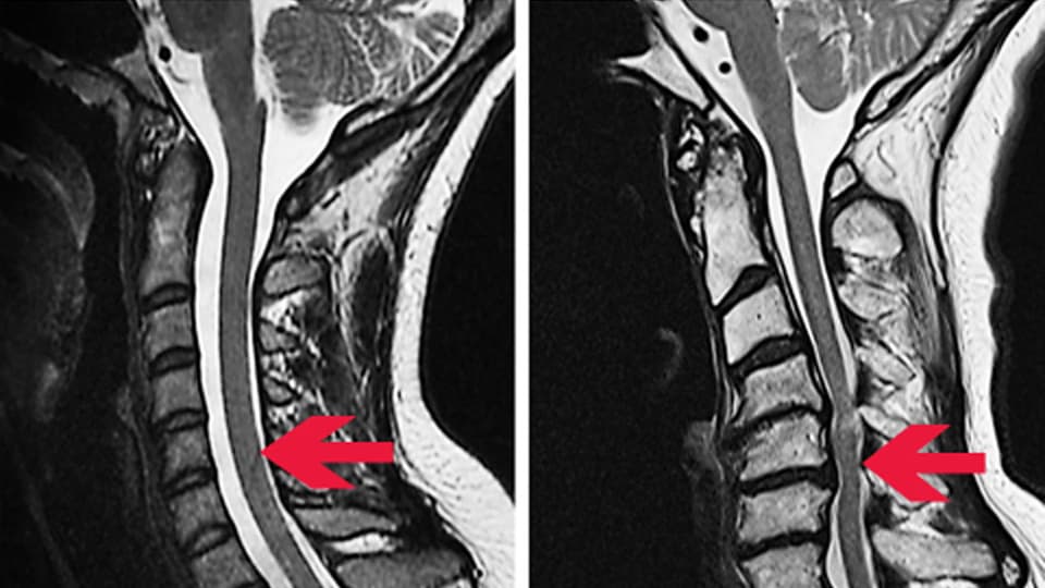 Zwei Röntgenaufnahmen der Wirbelsäule - rechts mit eingeengtem Rückenmark.