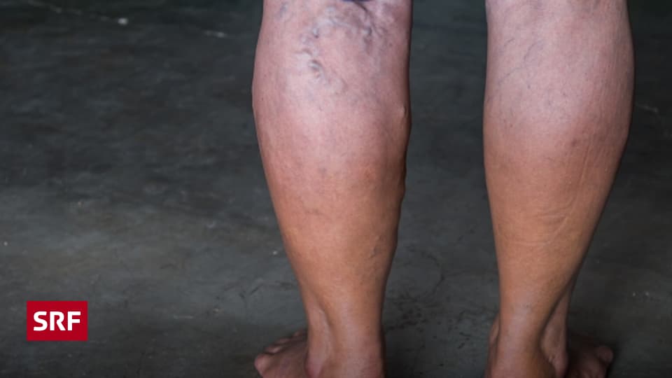 Thrombose Risiken und Gefahren Musikwelle Magazin SRF