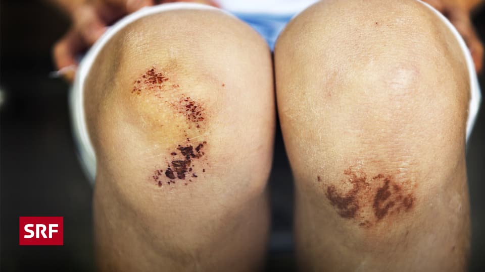 Körper & Geist - Warum Wunden jucken - Puls - SRF