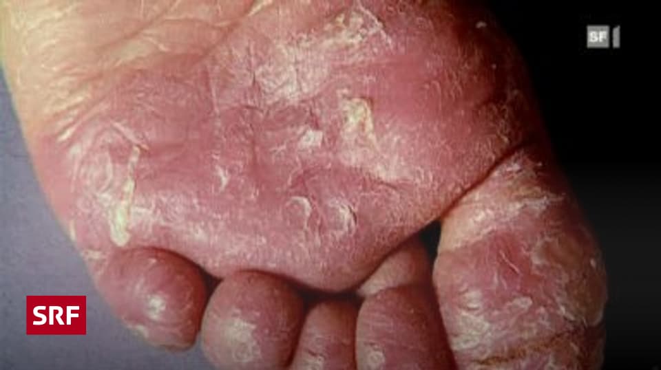 Alltag & Umwelt - Fusspilz aus dem Wäschekorb - Puls - SRF