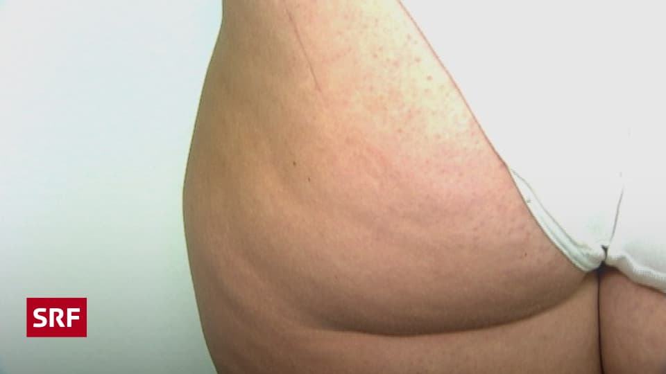 Cellulite bei männern am po