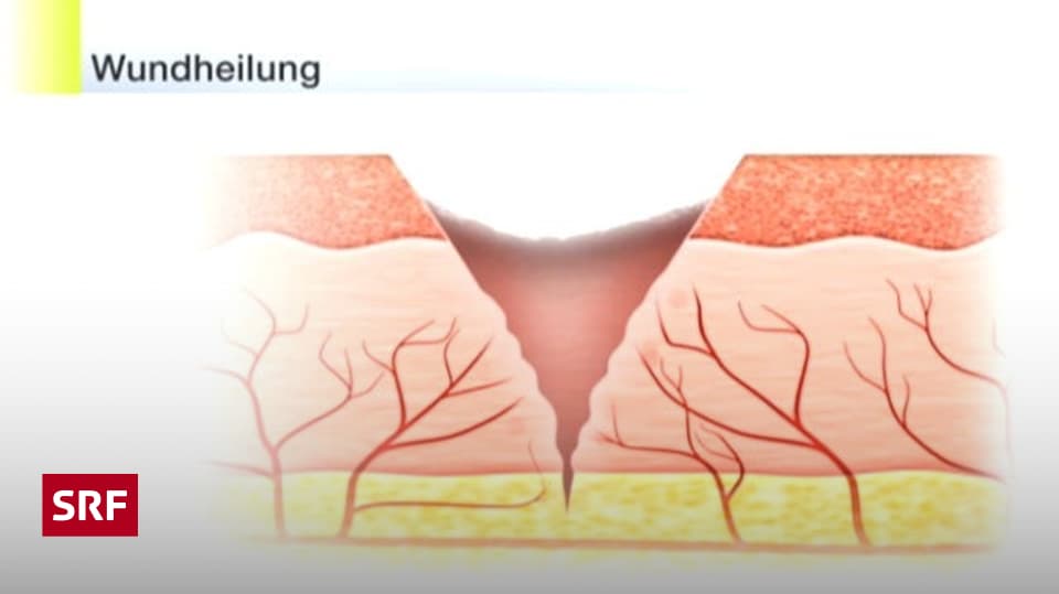 Chronische Wunden Wenn Verletzungen einfach nicht heilen wollen Wissen SRF