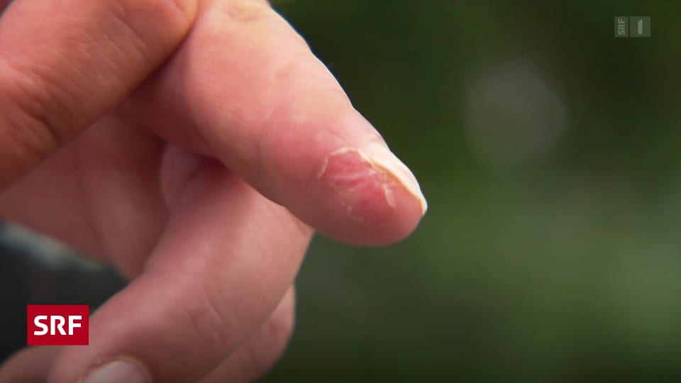Heilung fingerkuppe abgetrennt Wie lange