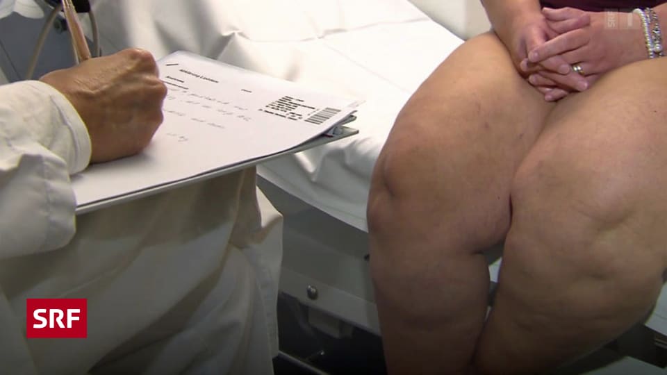Schmerzhaftes Lipodem Krankenkassen Knausern Bei Der Behandlung
