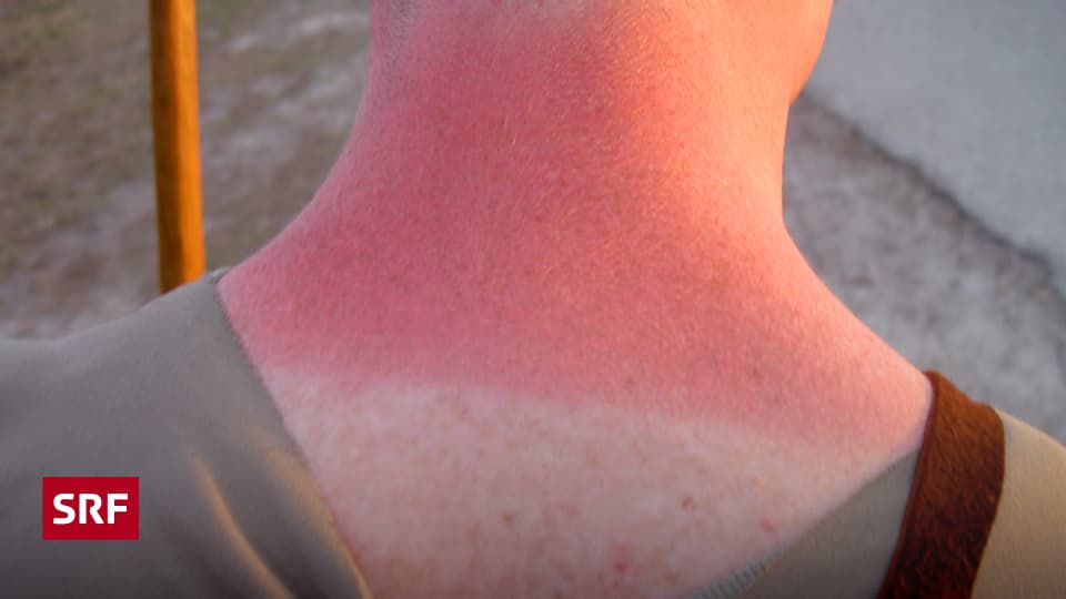 Durchblicker Wie entsteht ein Sonnenbrand? Zambo SRF