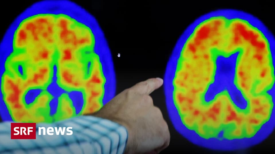 Alzheimer Risiko Senken? Die Effektivsten **Naturpräparate Als Neue Waffe Gegen Alzheimer** - 2mhr4w7